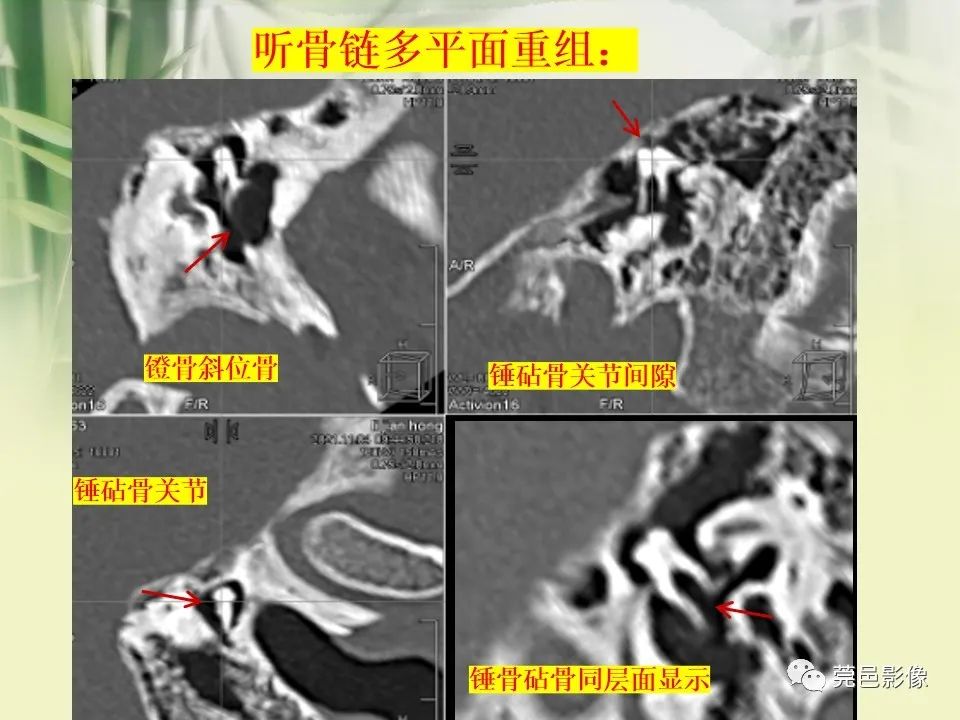 影像PPT - 【PPT】CT高分辨骨算法对中内耳扫描重建技术的探索与总结-21