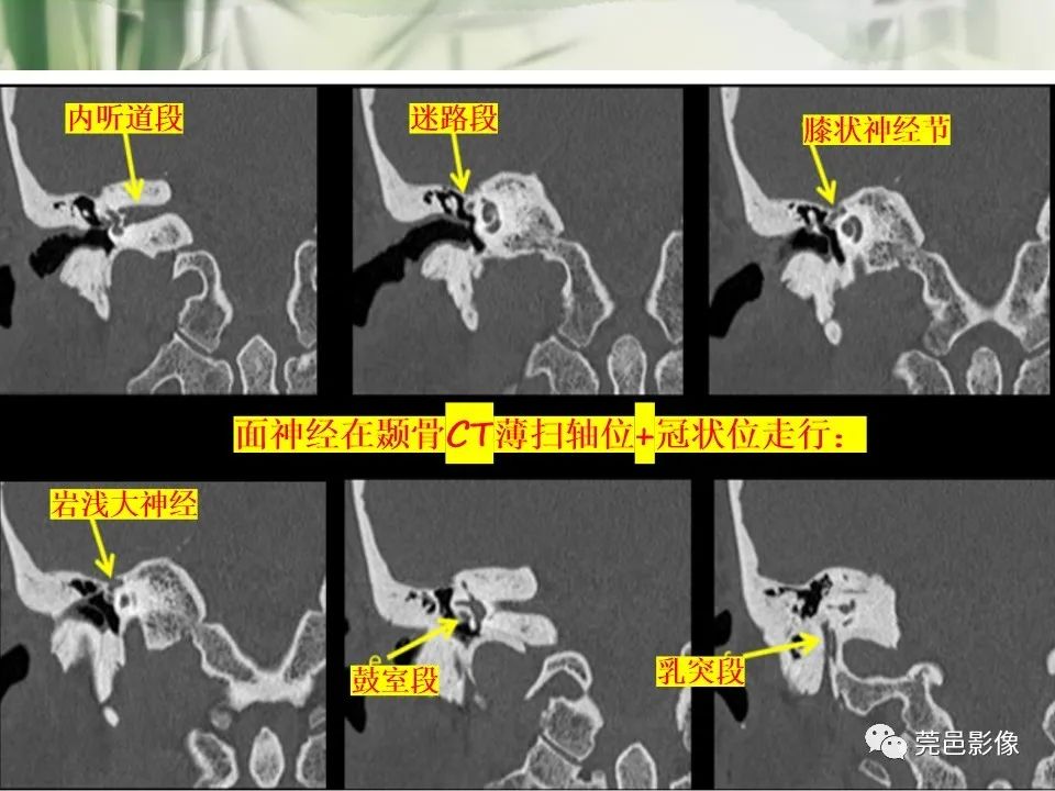 影像PPT - 【PPT】CT高分辨骨算法对中内耳扫描重建技术的探索与总结-22