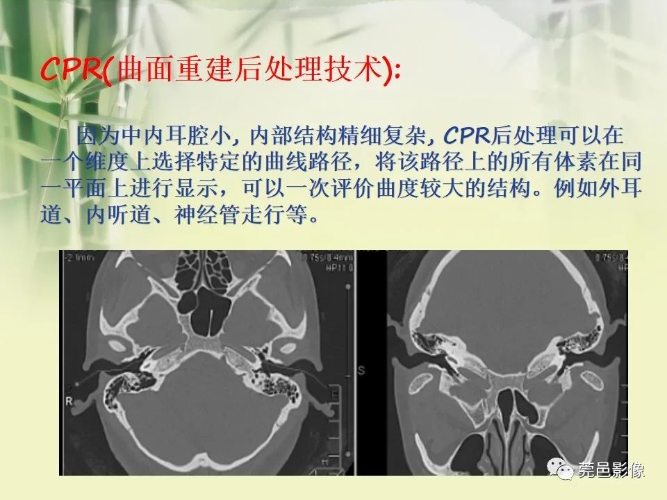 影像PPT - 【PPT】CT高分辨骨算法对中内耳扫描重建技术的探索与总结-24