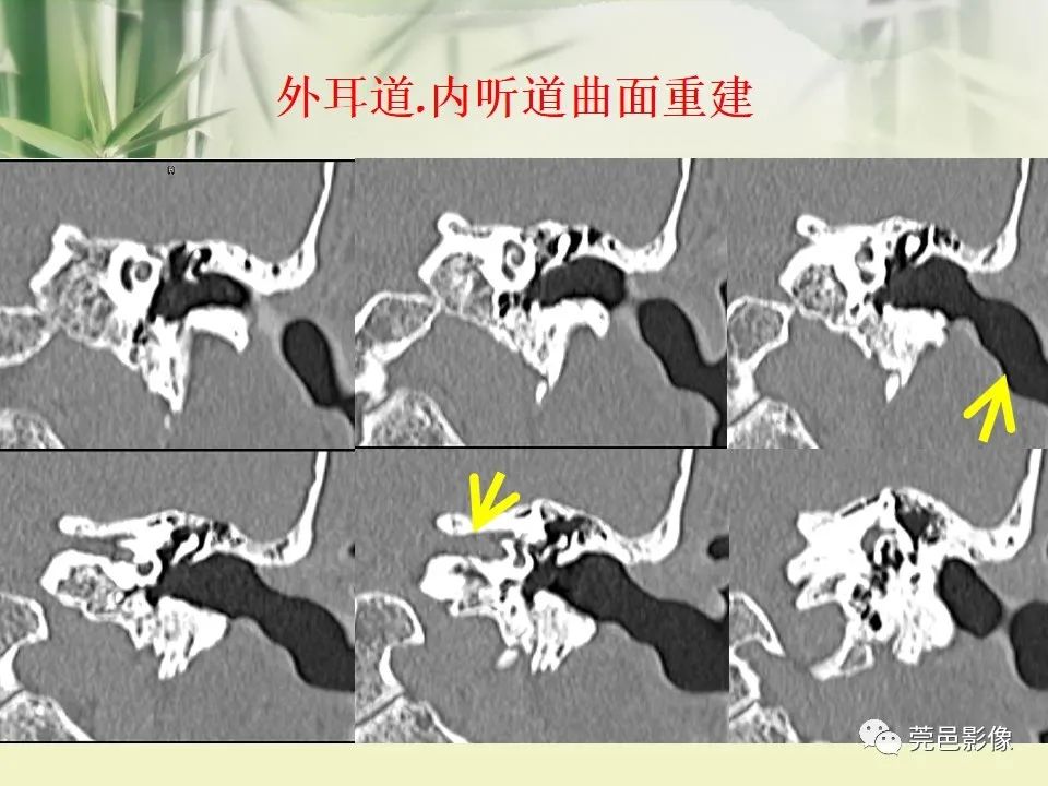 影像PPT - 【PPT】CT高分辨骨算法对中内耳扫描重建技术的探索与总结-25
