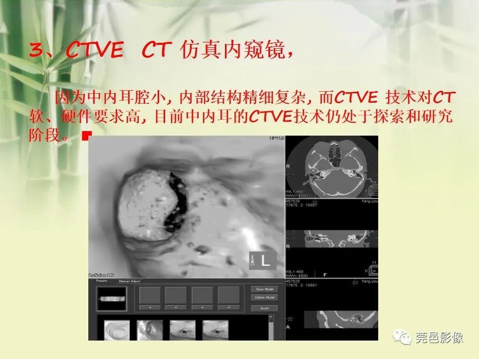 影像PPT - 【PPT】CT高分辨骨算法对中内耳扫描重建技术的探索与总结-27