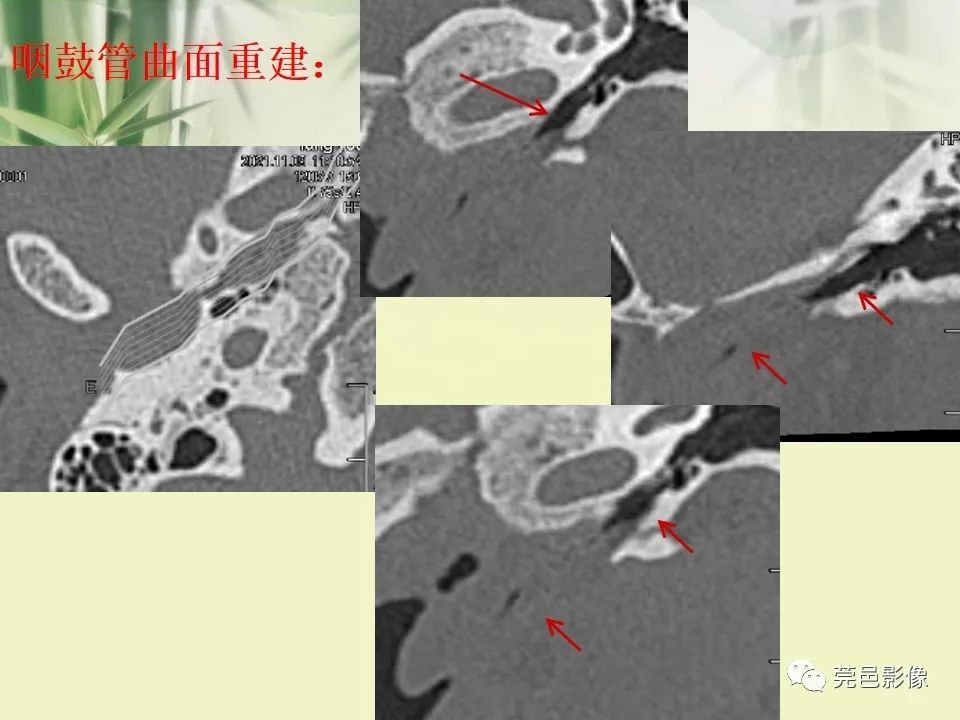 影像PPT - 【PPT】CT高分辨骨算法对中内耳扫描重建技术的探索与总结-26