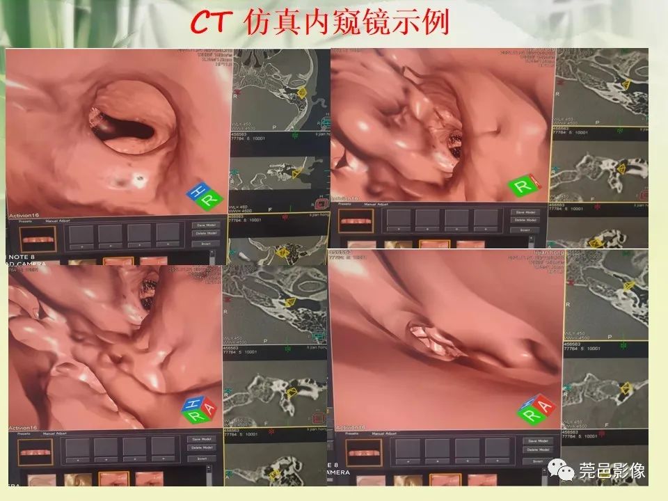 影像PPT - 【PPT】CT高分辨骨算法对中内耳扫描重建技术的探索与总结-28