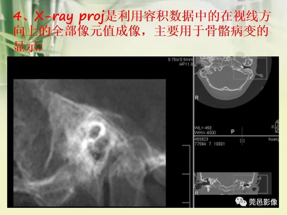 影像PPT - 【PPT】CT高分辨骨算法对中内耳扫描重建技术的探索与总结-31