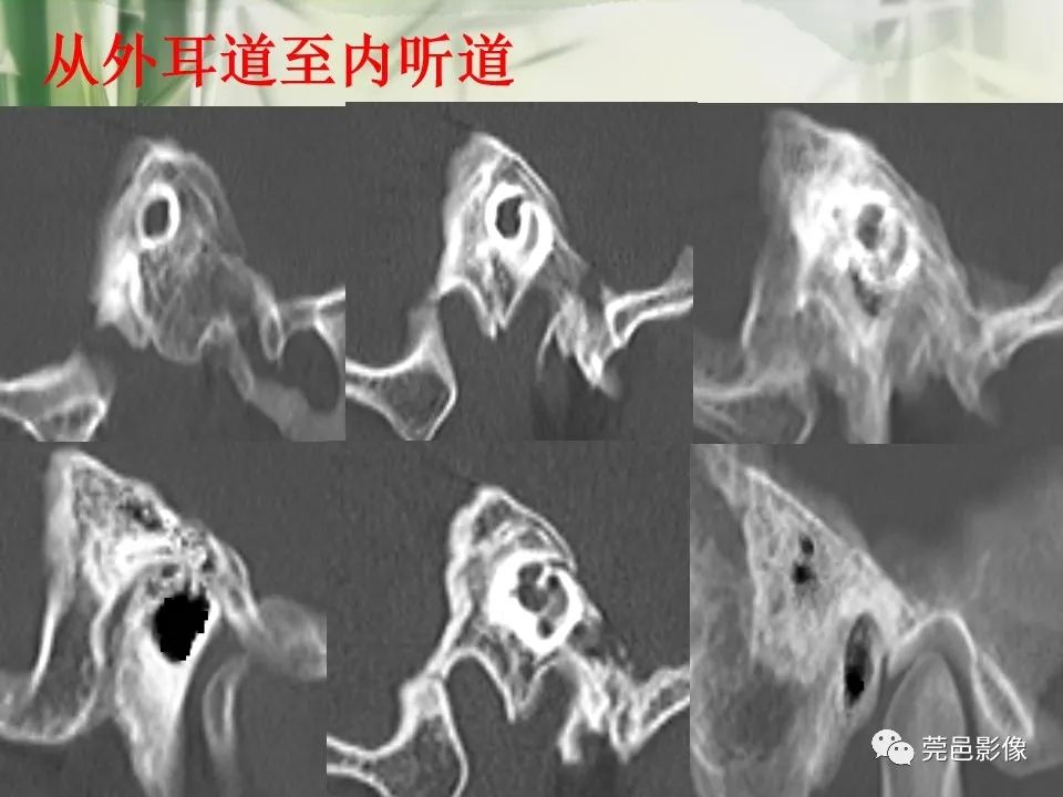 影像PPT - 【PPT】CT高分辨骨算法对中内耳扫描重建技术的探索与总结-32