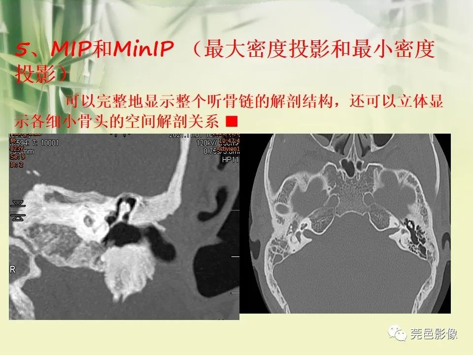 影像PPT - 【PPT】CT高分辨骨算法对中内耳扫描重建技术的探索与总结-34
