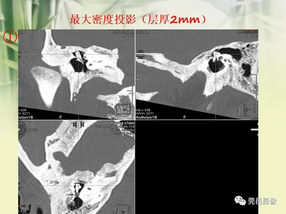 影像PPT - 【PPT】CT高分辨骨算法对中内耳扫描重建技术的探索与总结-35