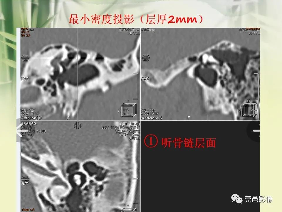 影像PPT - 【PPT】CT高分辨骨算法对中内耳扫描重建技术的探索与总结-37