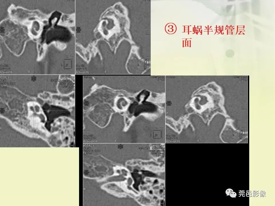 影像PPT - 【PPT】CT高分辨骨算法对中内耳扫描重建技术的探索与总结-39