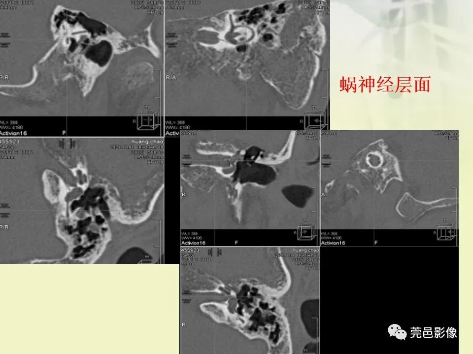 影像PPT - 【PPT】CT高分辨骨算法对中内耳扫描重建技术的探索与总结-40