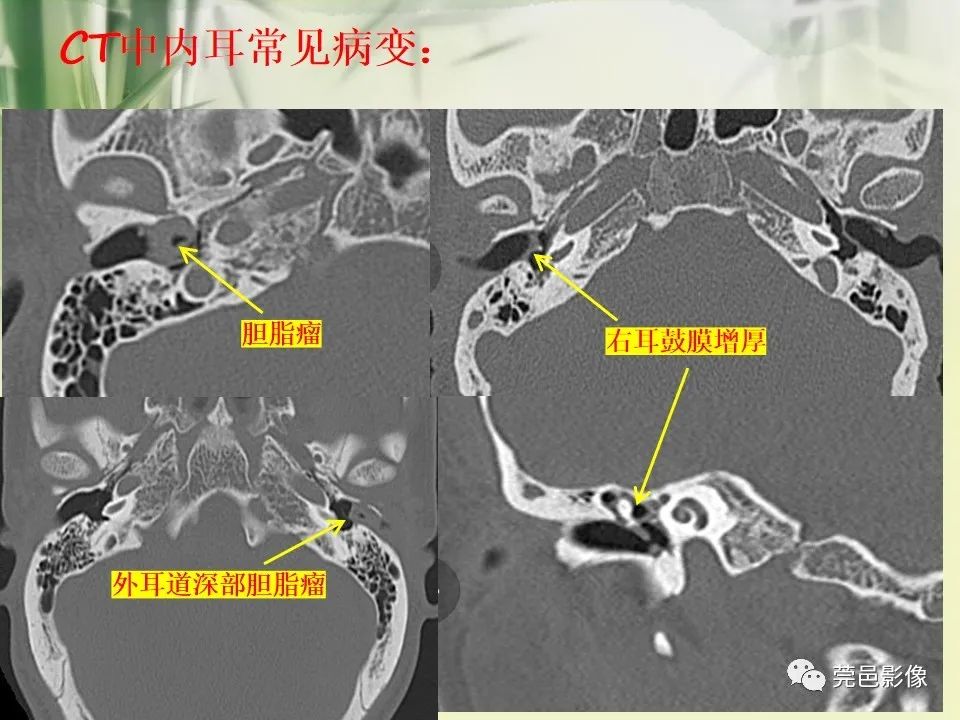 影像PPT - 【PPT】CT高分辨骨算法对中内耳扫描重建技术的探索与总结-41