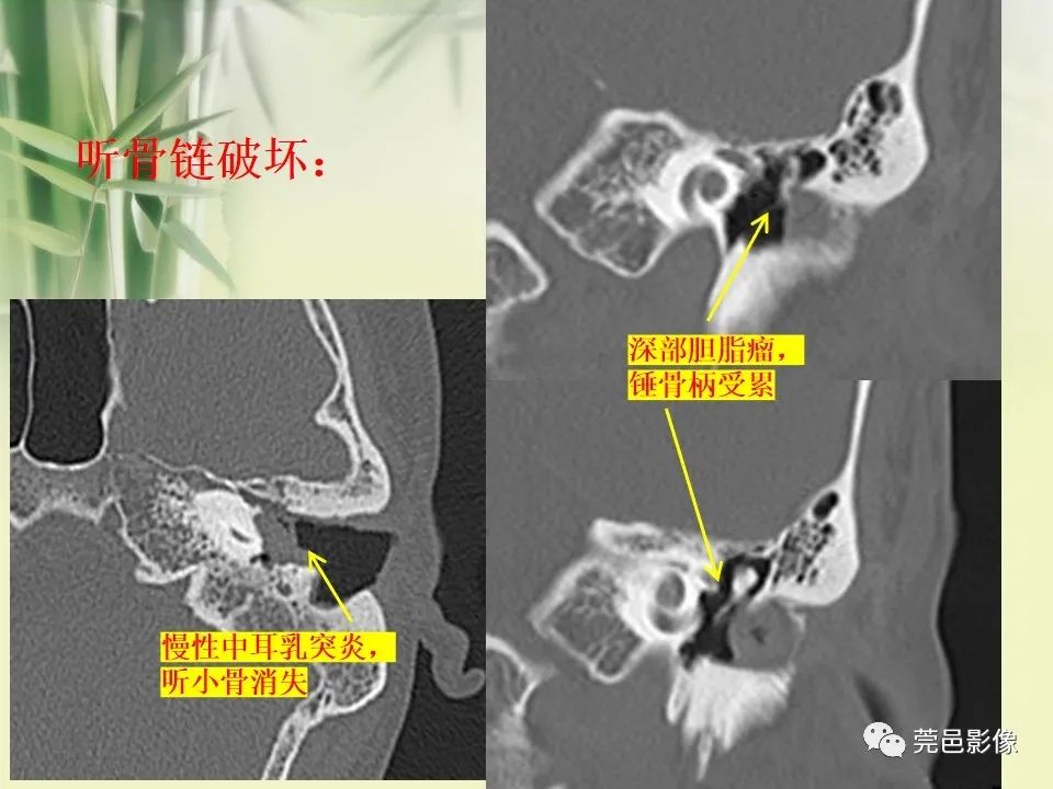影像PPT - 【PPT】CT高分辨骨算法对中内耳扫描重建技术的探索与总结-42