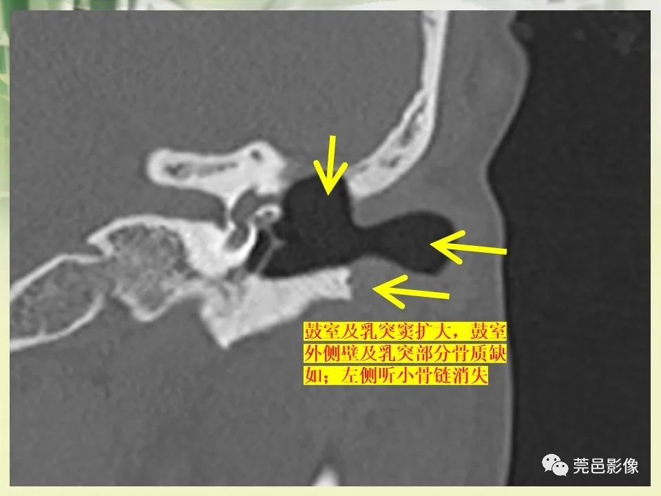影像PPT - 【PPT】CT高分辨骨算法对中内耳扫描重建技术的探索与总结-44