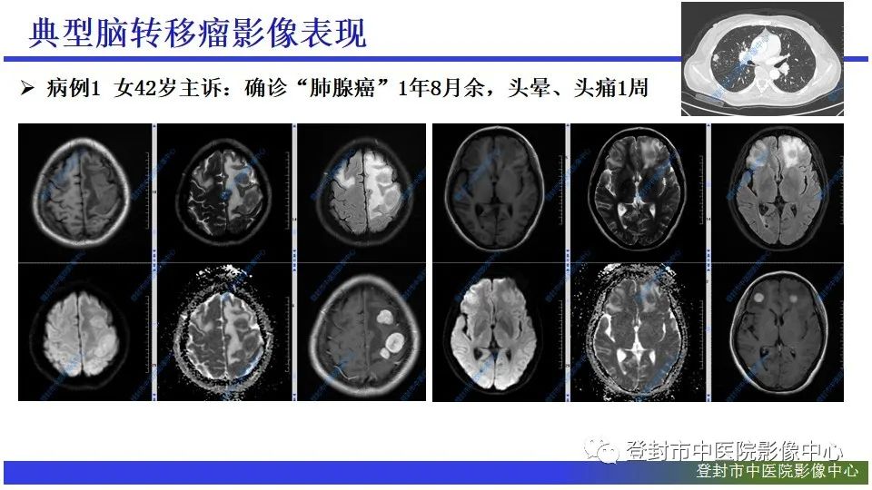 影像PPT - 【PPT】神经影像征象识别之池征-5