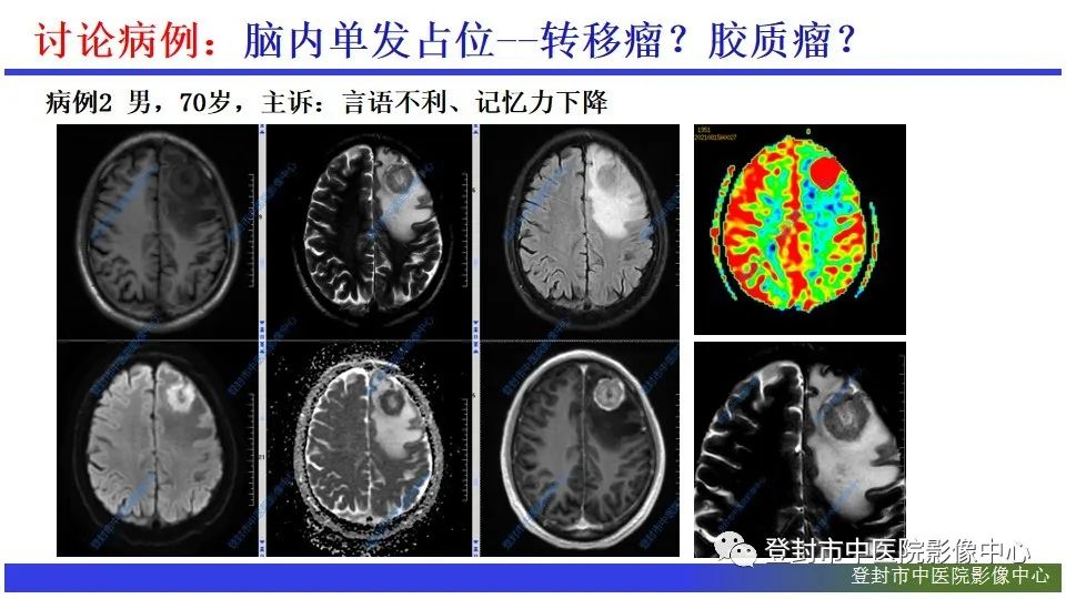影像PPT - 【PPT】神经影像征象识别之池征-6