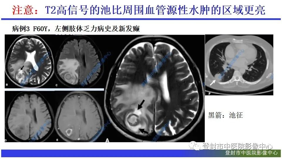 影像PPT - 【PPT】神经影像征象识别之池征-8