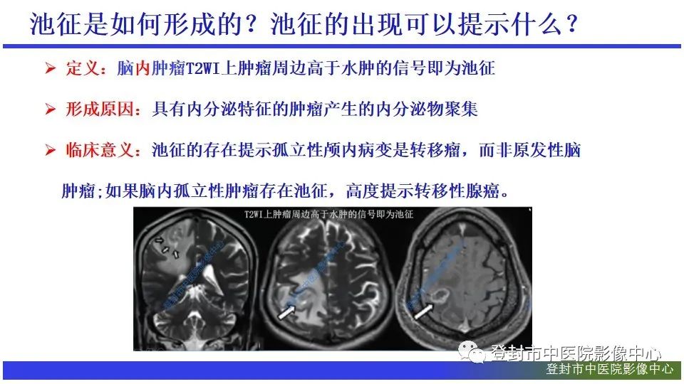 影像PPT - 【PPT】神经影像征象识别之池征-10