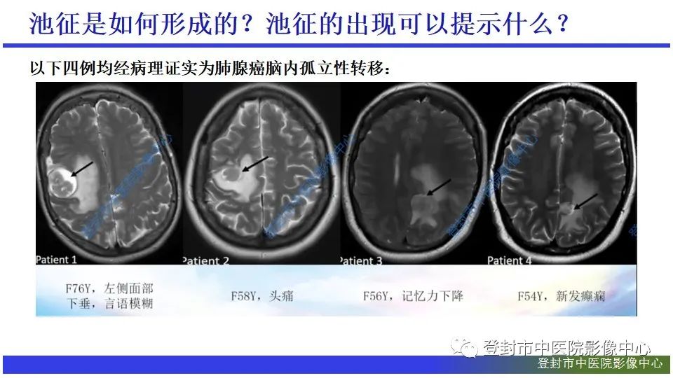 影像PPT - 【PPT】神经影像征象识别之池征-9