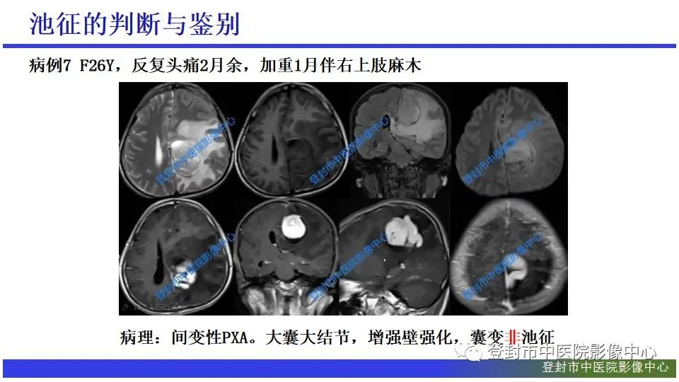 影像PPT - 【PPT】神经影像征象识别之池征-14