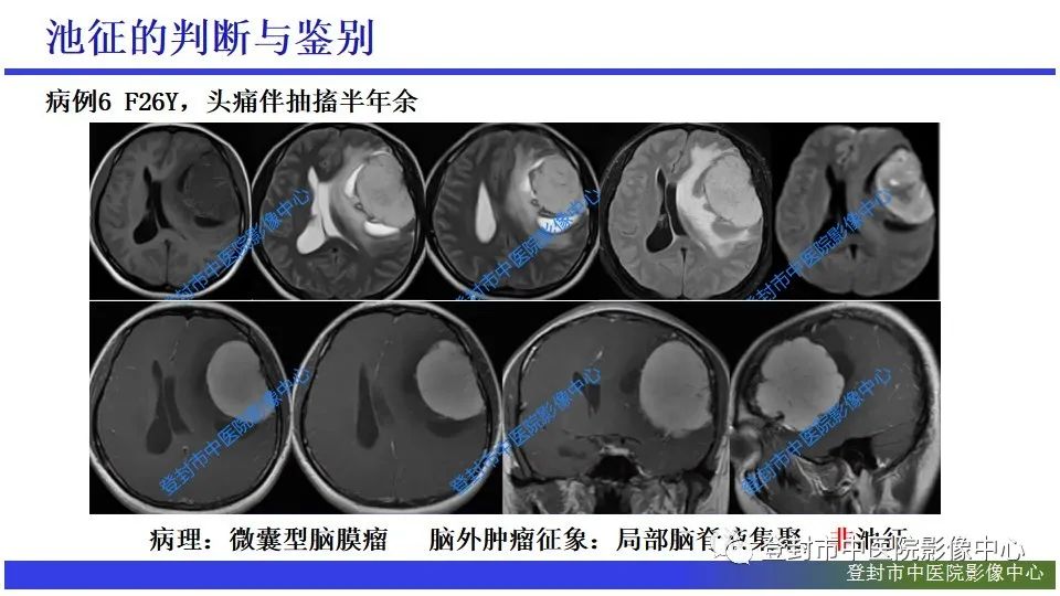 影像PPT - 【PPT】神经影像征象识别之池征-13