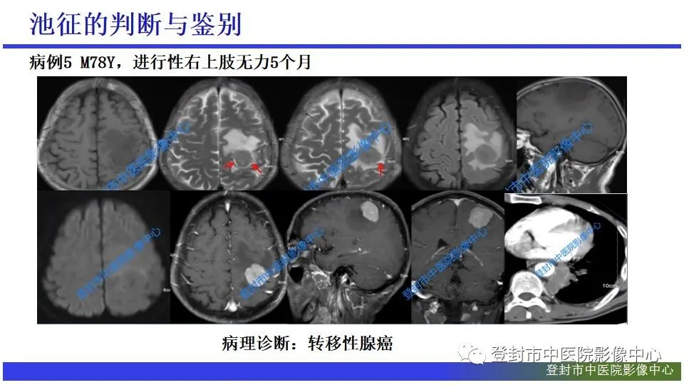 影像PPT - 【PPT】神经影像征象识别之池征-12