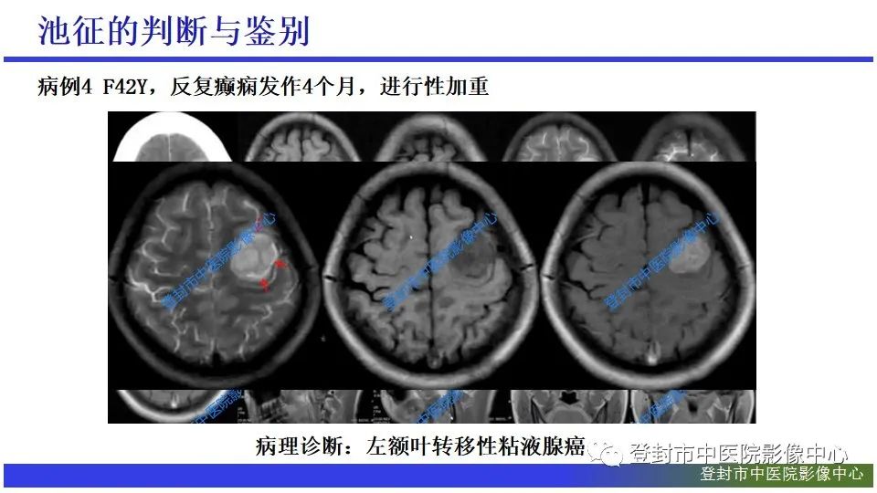 影像PPT - 【PPT】神经影像征象识别之池征-11