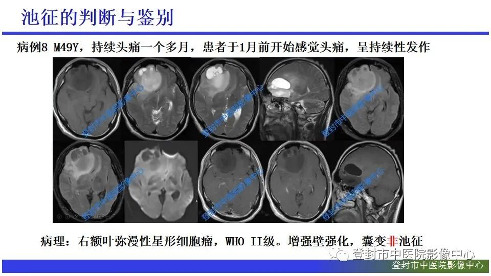 影像PPT - 【PPT】神经影像征象识别之池征-15