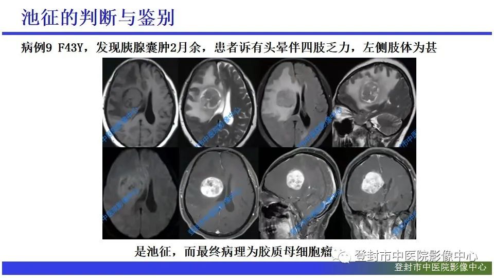 影像PPT - 【PPT】神经影像征象识别之池征-16