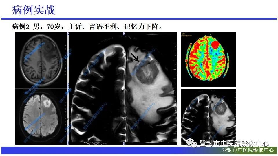 影像PPT - 【PPT】神经影像征象识别之池征-19