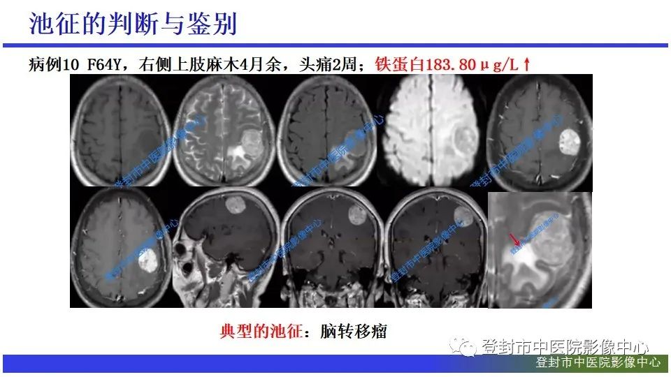 影像PPT - 【PPT】神经影像征象识别之池征-17