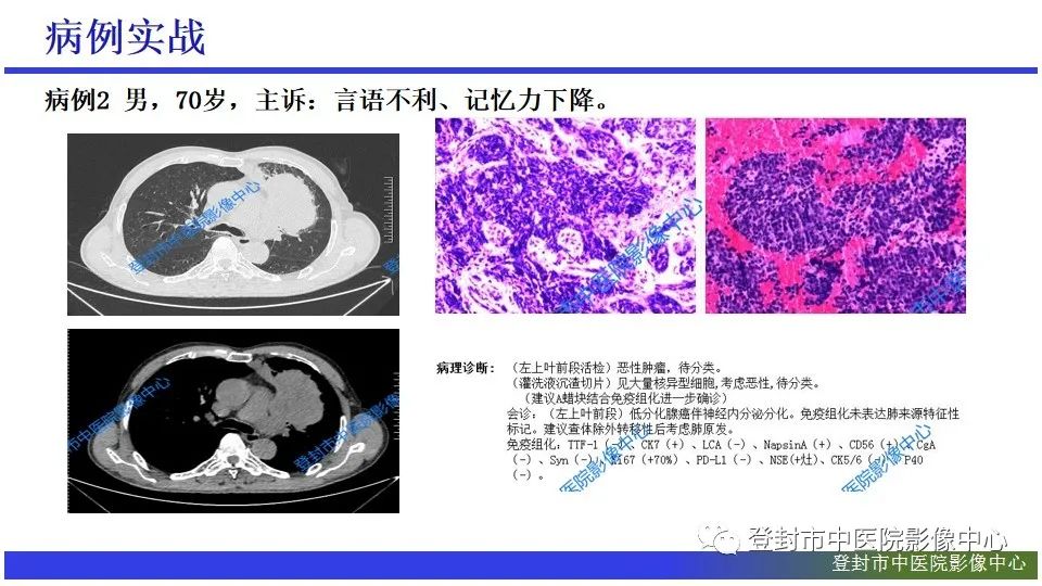 影像PPT - 【PPT】神经影像征象识别之池征-20