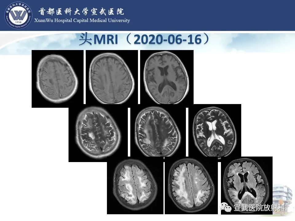 影像PPT - 【病例】进行性多灶性白质脑病1例CT及MR影像表现-5
