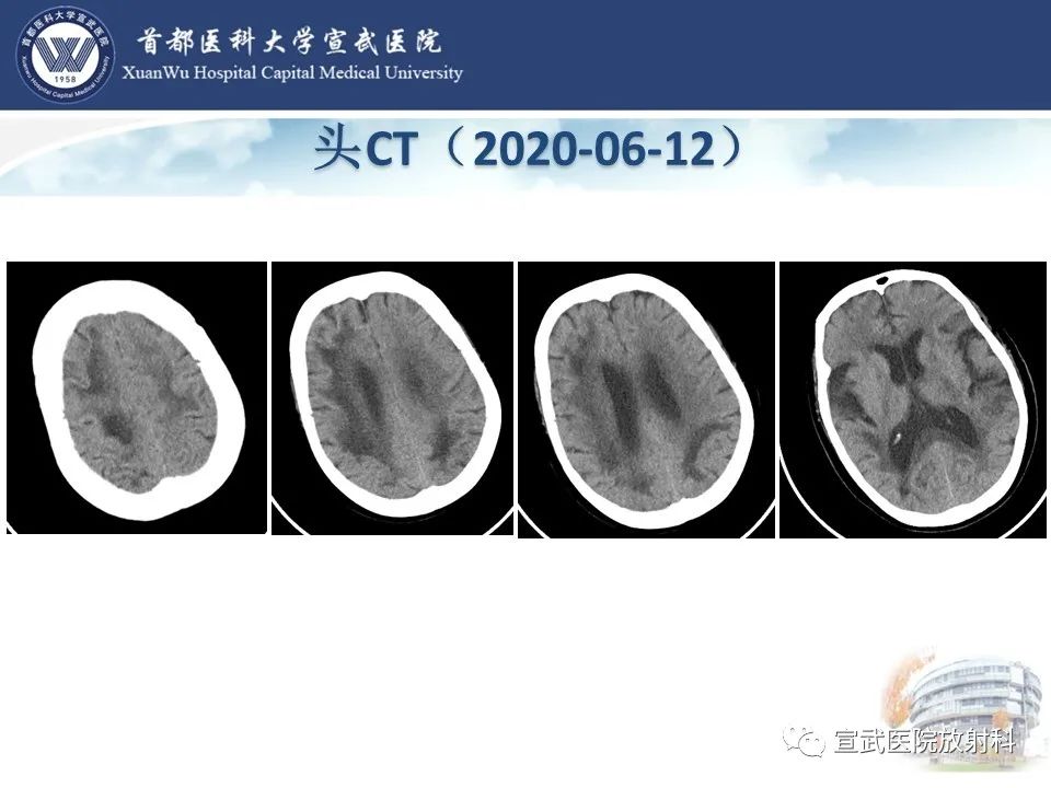 影像PPT - 【病例】进行性多灶性白质脑病1例CT及MR影像表现-4