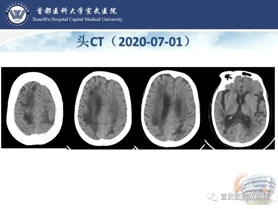 影像PPT - 【病例】进行性多灶性白质脑病1例CT及MR影像表现-7