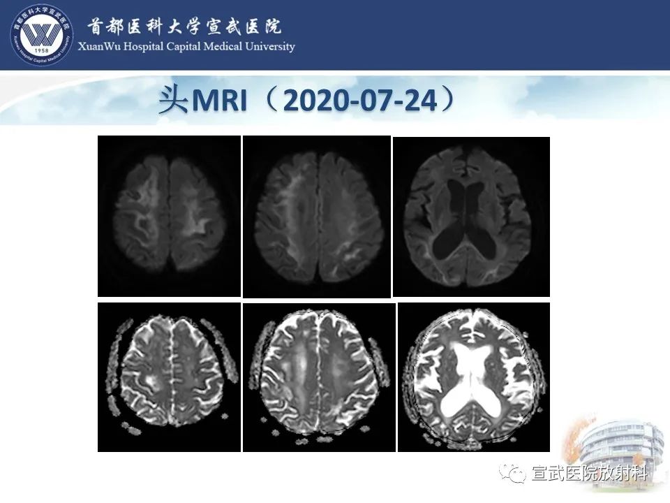 影像PPT - 【病例】进行性多灶性白质脑病1例CT及MR影像表现-9
