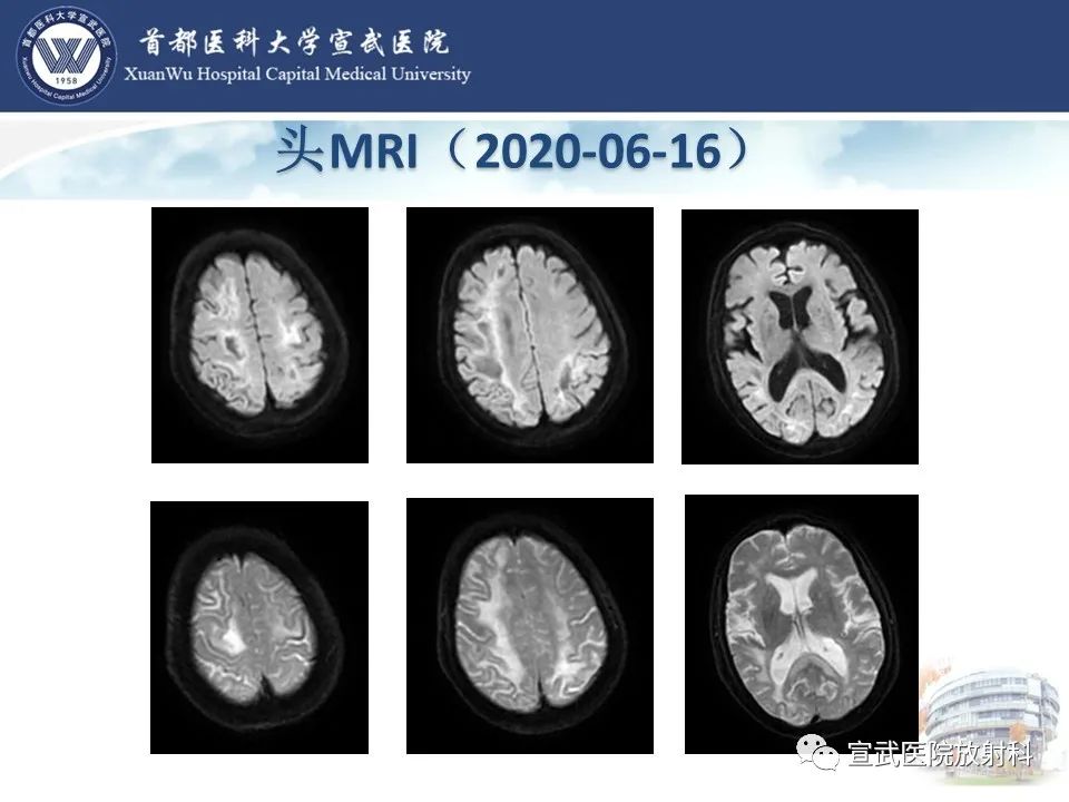 影像PPT - 【病例】进行性多灶性白质脑病1例CT及MR影像表现-6