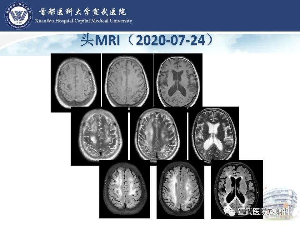 影像PPT - 【病例】进行性多灶性白质脑病1例CT及MR影像表现-8