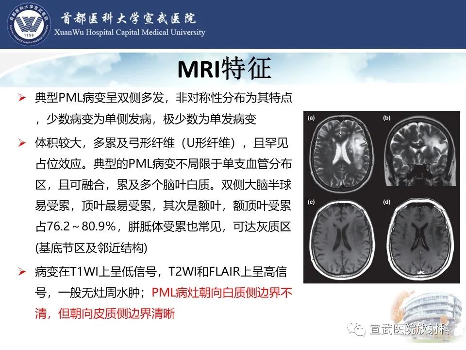 影像PPT - 【病例】进行性多灶性白质脑病1例CT及MR影像表现-16