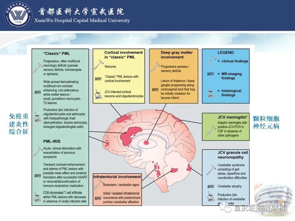 影像PPT - 【病例】进行性多灶性白质脑病1例CT及MR影像表现-21