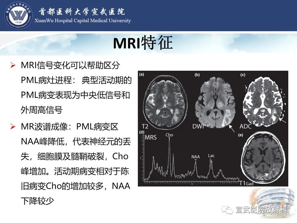 影像PPT - 【病例】进行性多灶性白质脑病1例CT及MR影像表现-18