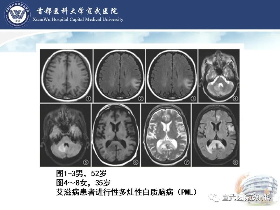 影像PPT - 【病例】进行性多灶性白质脑病1例CT及MR影像表现-19