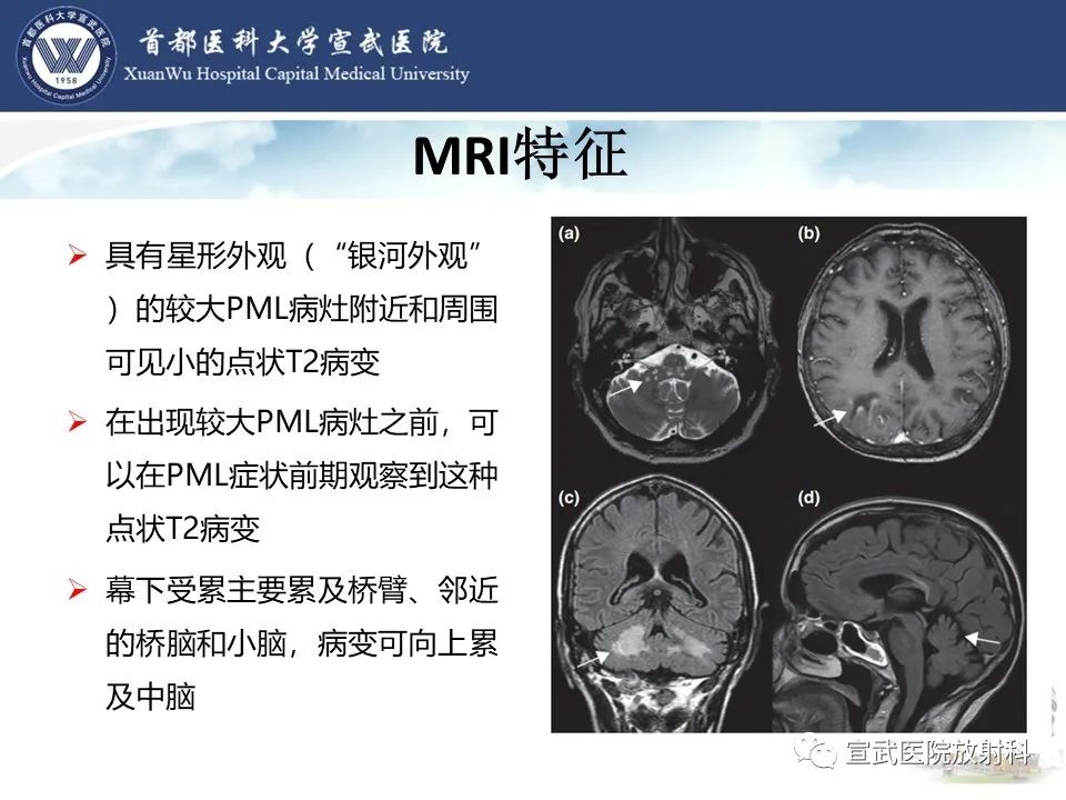 影像PPT - 【病例】进行性多灶性白质脑病1例CT及MR影像表现-17