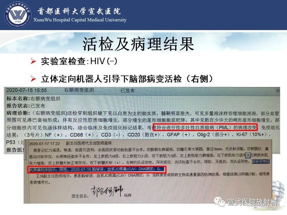 影像PPT - 【病例】进行性多灶性白质脑病1例CT及MR影像表现-11