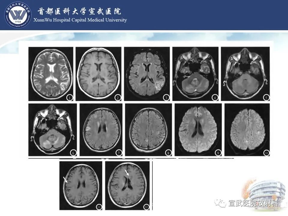 影像PPT - 【病例】进行性多灶性白质脑病1例CT及MR影像表现-20
