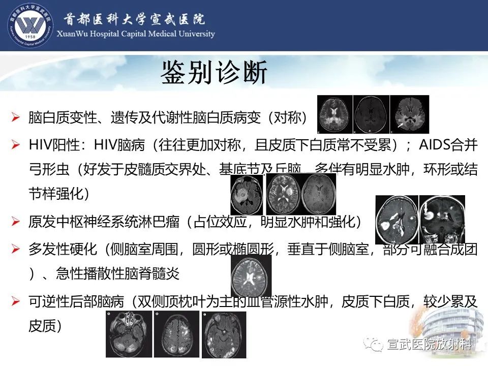 影像PPT - 【病例】进行性多灶性白质脑病1例CT及MR影像表现-23