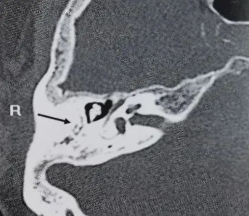 影像PPT - 颞骨8种常见解剖变异的识别与临床意义-4 影像PPT - 颞骨8种常见解剖变异的识别与临床意义-4