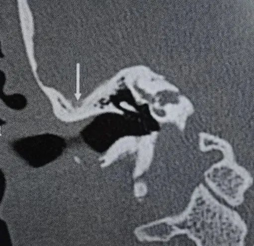 影像PPT - 颞骨8种常见解剖变异的识别与临床意义-6 影像PPT - 颞骨8种常见解剖变异的识别与临床意义-6