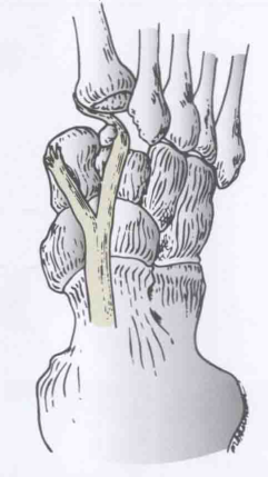 影像PPT - 为什么 Lisfranc 关节损伤处理那么重要-5 影像PPT - 为什么 Lisfranc 关节损伤处理那么重要-5