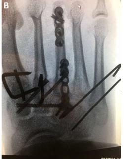 影像PPT - 为什么 Lisfranc 关节损伤处理那么重要-10 影像PPT - 为什么 Lisfranc 关节损伤处理那么重要-10