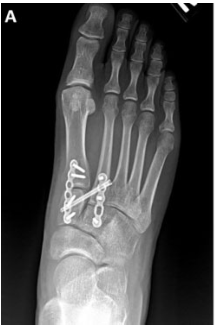 影像PPT - 为什么 Lisfranc 关节损伤处理那么重要-11 影像PPT - 为什么 Lisfranc 关节损伤处理那么重要-11